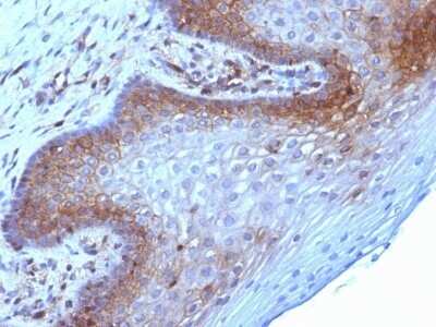 Immunohistochemistry-Paraffin: beta 2-Microglobulin Antibody (B2M/961) - Azide and BSA Free [NBP2-47704] - Formalin-fixed, paraffin-embedded human Cervical Carcinoma stained with beta 2-Microglobulin Antibody (B2M/961).