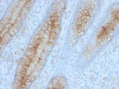 Immunohistochemistry-Paraffin: beta 2-Microglobulin Antibody (B2M/961) - Azide and BSA Free [NBP2-47704] - Human Colon Carcinoma stained with Beta-2-Microglobulin Monoclonal Antibody (B2M/961)