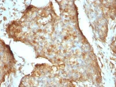 Immunohistochemistry-Paraffin: beta 2-Microglobulin Antibody (B2M/961) - Azide and BSA Free [NBP2-47704] - Formalin-fixed, paraffin-embedded human Gastric Carcinoma stained with beta 2-Microglobulin Antibody (B2M/961).