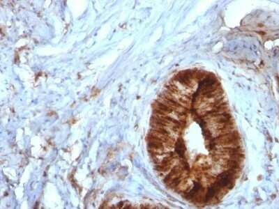 Immunohistochemistry-Paraffin: beta 2-Microglobulin Antibody (B2M/961) - Azide and BSA Free [NBP2-47704] - Human Cervical Carcinoma stained with Beta-2-Microglobulin Monoclonal Antibody (B2M/961).