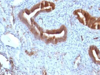 Immunohistochemistry-Paraffin: beta 2-Microglobulin Antibody (B2M/961) - Azide and BSA Free [NBP2-47704] - Human Endometrial Carcinoma stained with Beta-2-Microglobulin Monoclonal Antibody (B2M/961)