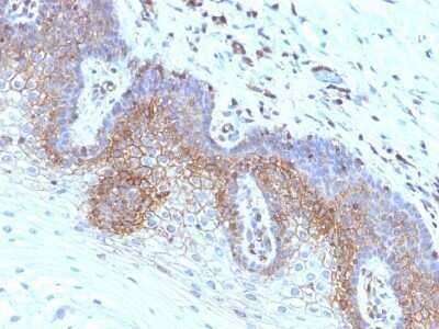 Immunohistochemistry-Paraffin: beta 2-Microglobulin Antibody (SPM617) - Azide and BSA Free [NBP2-47703] - Human Cervical Carcinoma stained with Beta-2-Microglobulin Monoclonal Antibody (SPM617)