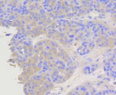 Immunohistochemistry-Paraffin: beta-Arrestin 1 Antibody (ST51-08) [NBP2-67510] - Analysis of paraffin-embedded human liver cancer tissue using anti-beta Arrestin 1 antibody. Counter stained with hematoxylin.