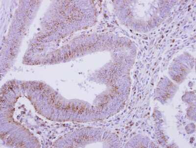 Immunohistochemistry-Paraffin: beta COP Antibody [NBP2-15577] - Immunohistochemical analysis of paraffin-embedded Colon ca, using antibody at 1:500 dilution.