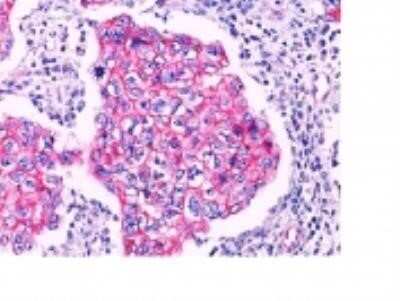 Immunohistochemistry-Paraffin: beta-Catenin Antibody - BSA Free [NBP2-33124] - Formalin-fixed, paraffin-embedded human breast ductal carcinoma stained with beta- Catenin antibody (1:100), peroxidase-conjugate and Warp Red chromogen (20X). Note specific membrane staining in ductal carcinoma.