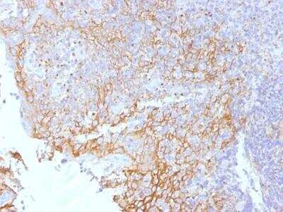 Immunohistochemistry-Paraffin: beta-Catenin Antibody (5H10) [NBP2-53359] - Immunohistochemistry-Paraffin: Desmoglein-3 Antibody (5H10) [NBP2-54596] - Formalin-fixed, paraffin-embedded human Tonsil stained with Beta-Catenin (p120) Monoclonal Antibody (5H10).