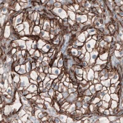 Immunohistochemistry-Paraffin: beta-Catenin Antibody (CL3689) [NBP2-61628] - Staining of human renal cancer shows membranous positivity in tumor cells.