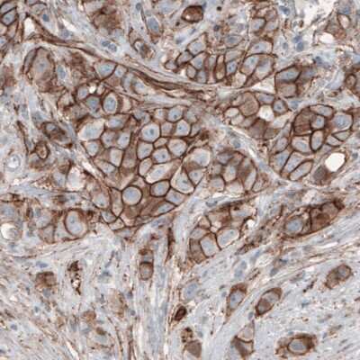 Immunohistochemistry-Paraffin: beta-Catenin Antibody (CL3691) [NBP2-61629] - Staining of human breast cancer shows membranous immunoreactivity in tumor cells.