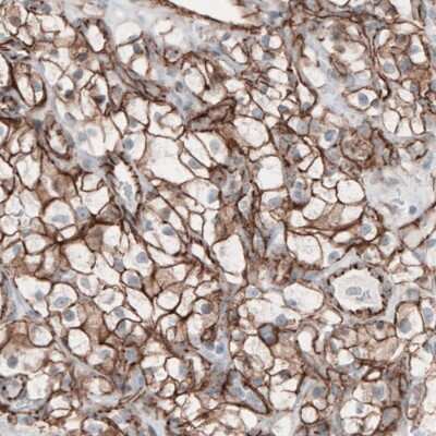 Immunohistochemistry-Paraffin: beta-Catenin Antibody (CL3691) [NBP2-61629] - Staining of human renal cancer shows membranous positivity in tumor cells.