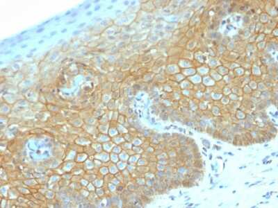 Immunohistochemistry-Paraffin: beta-Catenin Antibody (CTNNB1/2030R) [NBP2-79753] - Formalin-fixed, paraffin-embedded human Cervical Carcinoma stained with beta-Catenin Antibody (CTNNB1/2030R).