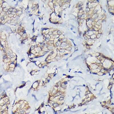 Immunohistochemistry-Paraffin: beta-Catenin Antibody [NBP2-92970] - Immunohistochemistry of paraffin-embedded human breast cancer using [KO Validated] beta-Catenin Rabbit pAb (NBP2-92970) at dilution of 1:100 (40x lens). Perform high pressure antigen retrieval with 10 mM citrate buffer pH 6.0 before commencing with IHC staining protocol.