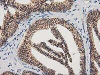 Immunohistochemistry: beta-Catenin Antibody (OTI12H7) - Azide and BSA Free [NBP2-70509] - Staining of paraffin-embedded Carcinoma of Human prostate tissue using anti-beta Catenin mouse monoclonal antibody.