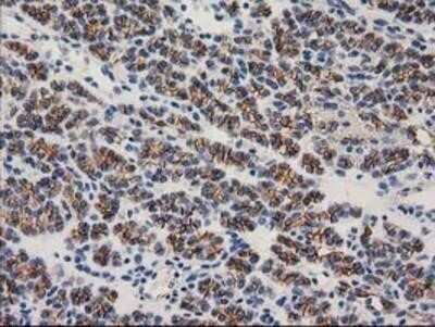 Immunohistochemistry: beta-Catenin Antibody (OTI12H7) - Azide and BSA Free [NBP2-70509] - Staining of paraffin-embedded Carcinoma of Human thyroid tissue using anti-beta Catenin mouse monoclonal antibody.