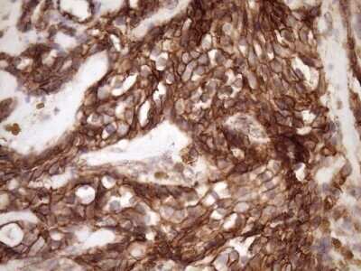 Immunohistochemistry: beta-Catenin Antibody (OTI2F10) - Azide and BSA Free [NBP2-70511] - Analysis of Adenocarcinoma of Human breast tissue. (Heat-induced epitope retrieval by Tris-EDTA, pH8.0)(1:150)