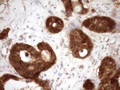Immunohistochemistry: beta-Catenin Antibody (OTI2F10) - Azide and BSA Free [NBP2-70511] - Analysis of Adenocarcinoma of Human colon tissue. (Heat-induced epitope retrieval by Tris-EDTA, pH8.0)(1:150)