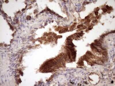 Immunohistochemistry: beta-Catenin Antibody (OTI2F10) - Azide and BSA Free [NBP2-70511] - Analysis of Carcinoma of Human lung tissue.(Heat-induced epitope retrieval by Tris-EDTA, pH8.0)