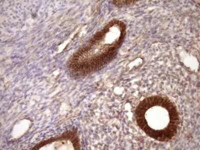 Immunohistochemistry: beta-Catenin Antibody (OTI2F10) - Azide and BSA Free [NBP2-70511] - Analysis of Carcinoma of Human pancreas tissue. (Heat-induced epitope retrieval by Tris-EDTA, pH8.0)