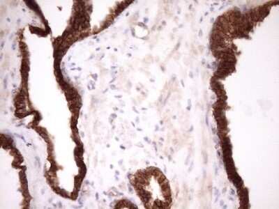 Immunohistochemistry: beta-Catenin Antibody (OTI2F10) - Azide and BSA Free [NBP2-70511] - Analysis of Carcinoma of Human prostate tissue. (Heat-induced epitope retrieval by Tris-EDTA, pH8.0)