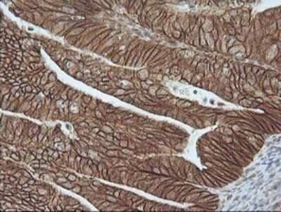 Immunohistochemistry: beta-Catenin Antibody (OTI9C1) - Azide and BSA Free [NBP2-70508] - Analysis of Adenocarcinoma of Human endometrium tissue. (Heat-induced epitope retrieval by 10mM citric buffer, pH6.0, 120C for 3min)