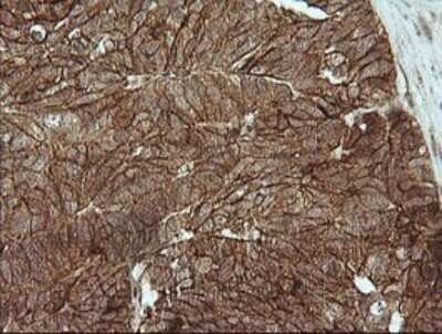 Immunohistochemistry: beta-Catenin Antibody (OTI9C1) - Azide and BSA Free [NBP2-70508] - Analysis of Adenocarcinoma of Human ovary tissue. (Heat-induced epitope retrieval by 10mM citric buffer, pH6.0, 120C for 3min)