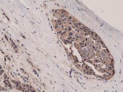 Immunohistochemistry-Paraffin: beta-Catenin Antibody (RM276) [NBP2-61498] - Immunohistochemical staining of formalin fixed and paraffin embedded Human breast cancer tissue sections using NBP2-61498.