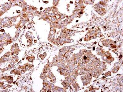 Immunohistochemistry-Paraffin: beta-Galactosidase-1/GLB1 Antibody [NBP1-32018] -  Human ovarian carcinoma.beta-Gal antibody [N2C3] dilution: 1:500. Antigen Retrieval: Trilogy™ (EDTA based, pH 8.0) buffer, 15min.