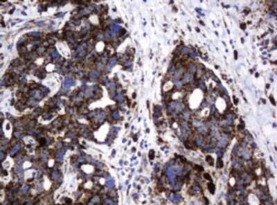 Immunohistochemistry: beta-Galactosidase-1/GLB1 Antibody (OTI1C9) - Azide and BSA Free [NBP2-70829] - Analysis of Adenocarcinoma of Human breast tissue. (Heat-induced epitope retrieval by 10mM citric buffer, pH6.0, 120C for 3min)