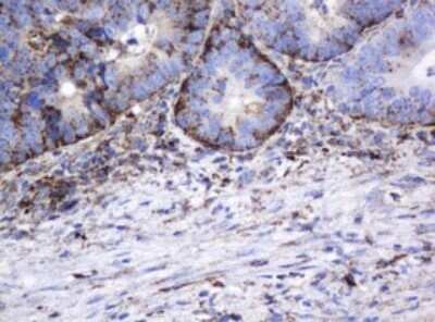 Immunohistochemistry: beta-Galactosidase-1/GLB1 Antibody (OTI1C9) - Azide and BSA Free [NBP2-70829] - Analysis of Adenocarcinoma of Human colon tissue. (Heat-induced epitope retrieval by 10mM citric buffer, pH6.0, 120C for 3min)