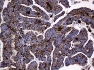 Immunohistochemistry: beta-Galactosidase-1/GLB1 Antibody (OTI1C9) - Azide and BSA Free [NBP2-70829] - Analysis of Adenocarcinoma of Human endometrium tissue. (Heat-induced epitope retrieval by 10mM citric buffer, pH6.0, 120C for 3min)