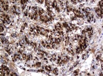 Immunohistochemistry: beta-Galactosidase-1/GLB1 Antibody (OTI1C9) - Azide and BSA Free [NBP2-70829] - Analysis of Carcinoma of Human liver tissue.(Heat-induced epitope retrieval by 10mM citric buffer, pH6.0, 120C for 3min)