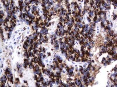 Immunohistochemistry: beta-Galactosidase-1/GLB1 Antibody (OTI1C9) - Azide and BSA Free [NBP2-70829] - Analysis of Carcinoma of Human pancreas tissue. (Heat-induced epitope retrieval by 10mM citric buffer, pH6.0, 120C for 3min)