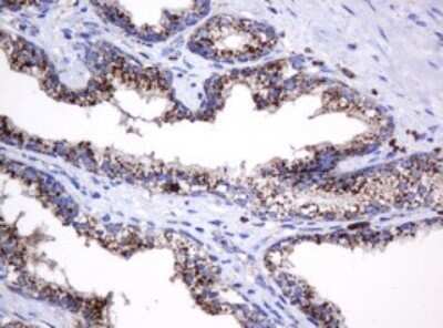 Immunohistochemistry: beta-Galactosidase-1/GLB1 Antibody (OTI1C9) - Azide and BSA Free [NBP2-70829] - Analysis of Carcinoma of Human prostate tissue. (Heat-induced epitope retrieval by 10mM citric buffer, pH6.0, 120C for 3min)