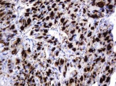 Immunohistochemistry: beta-Galactosidase-1/GLB1 Antibody (OTI1C9) - Azide and BSA Free [NBP2-70829] - Analysis of Carcinoma of Human thyroid tissue. (Heat-induced epitope retrieval by 10mM citric buffer, pH6.0, 120C for 3min)