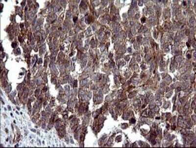 Immunohistochemistry: beta I Tubulin Antibody (OTI4A3) - Azide and BSA Free [NBP2-72225] - Analysis of Adenocarcinoma of Human colon tissue. (Heat-induced epitope retrieval by 10mM citric buffer, pH6.0, 120C for 3min)