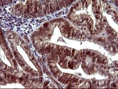 Immunohistochemistry: beta I Tubulin Antibody (OTI4A3) - Azide and BSA Free [NBP2-72225] - Analysis of Adenocarcinoma of Human endometrium tissue. (Heat-induced epitope retrieval by 10mM citric buffer, pH6.0, 120C for 3min)