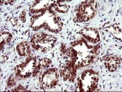 Immunohistochemistry: beta I Tubulin Antibody (OTI4A3) - Azide and BSA Free [NBP2-72225] - Analysis of Carcinoma of Human prostate tissue. (Heat-induced epitope retrieval by 10mM citric buffer, pH6.0, 120C for 3min)