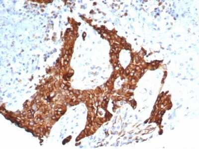 Immunohistochemistry-Paraffin: beta-III Tubulin Antibody (TUBB3/7090R) [NBP3-13837] - Formalin-fixed, paraffin-embedded human ovarian carcinoma stained with beta-III Tubulin antibody (TUBB3/7090R).