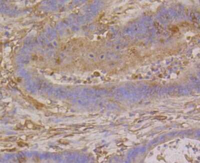 Immunohistochemistry-Paraffin: beta Tubulin Antibody (SR25-04) [NBP2-67341] - Analysis of paraffin-embedded human colon cancer tissue using anti-beta Tubulin antibody. Counter stained with hematoxylin.