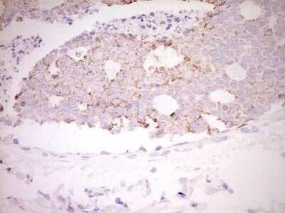 Immunohistochemistry: c-Fos Antibody (OTI7D6) - Azide and BSA Free [NBP2-70764] - Analysis of Adenocarcinoma of Human breast tissue. (Heat-induced epitope retrieval by 1 mM EDTA in 10mM Tris, pH8.5, 120C for 3min)