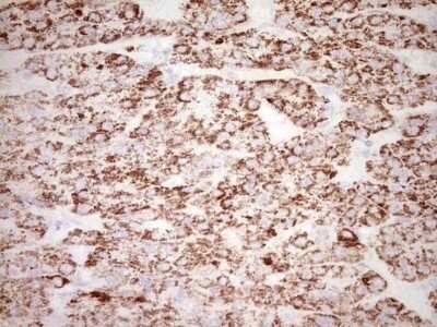 Immunohistochemistry: c-Fos Antibody (OTI7D6) - Azide and BSA Free [NBP2-70764] - Analysis of Carcinoma of Human liver tissue. (Heat-induced epitope retrieval by 1 mM EDTA in 10mM Tris, pH8.5, 120C for 3min)