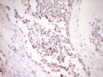 Immunohistochemistry: c-Fos Antibody (OTI7D6) - Azide and BSA Free [NBP2-70764] - Analysis of Carcinoma of Human lung tissue. (Heat-induced epitope retrieval by 1 mM EDTA in 10mM Tris, pH8.5, 120C for 3min)