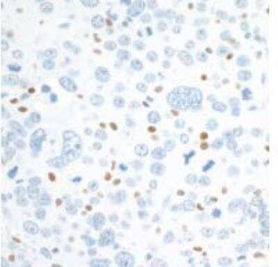 Immunohistochemistry: c-Maf Antibody [NBP3-14672] - Sample: FFPE section of mouse renal cell carcinoma.Antibody: Rabbit anti-c-MAF recombinant monoclonalantibody used at 1:125.Secondary: HRP-conjugated goat anti-rabbit IgG Substrate: DAB.