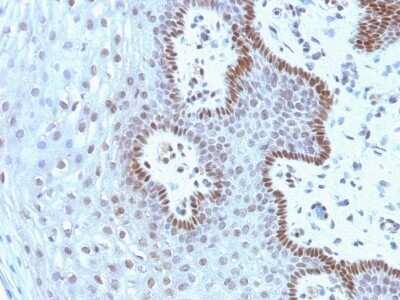 Immunohistochemistry-Paraffin: c-Myc Antibody (9E10.3) - Azide and BSA Free [NBP2-47738] - Human Cervical Carcinoma stained with c-myc Monoclonal Antibody (9E10.3).