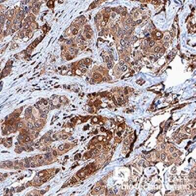 Immunohistochemistry: c-Myc Antibody (9E10) - Azide and BSA Free [NBP2-80675] - c-Myc was detected in immersion fixed paraffin-embedded sections of human breast cancer using anti-human mouse monoclonal antibody (Catalog # NB600-302, clone 9E10) at 1:50 dilution overnight at 4 C. Tissue was stained using the VisuCyte anti-mouse HRP po