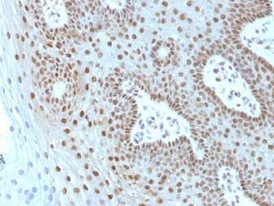 Immunohistochemistry-Paraffin: c-Myc Antibody (MYC275 + MYC909) - Azide and BSA Free [NBP2-47739] - Human Cervical Carcinoma stained with c-myc Monoclonal Antibody (MYC275 + MYC909).