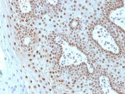 Immunohistochemistry-Paraffin: c-Myc Antibody (MYC275 + MYC909) [NBP2-45147] - Human Cervical Carcinoma stained with c-myc Monoclonal Antibody (MYC275 + MYC909).