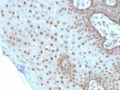 Immunohistochemistry-Paraffin: c-Myc Antibody (MYC275) - IHC-Prediluted [NBP2-45143] - Formalin-fixed, paraffin-embedded human Cerivcal carcinoma stained with c-Myc Monoclonal Antibody (MYC275).