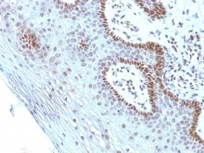 Immunohistochemistry-Paraffin: c-Myc Antibody (SPM237) - Azide and BSA Free [NBP2-86682] - Human Cervical Carcinoma stained with c-myc Monoclonal Antibody (SPM237).