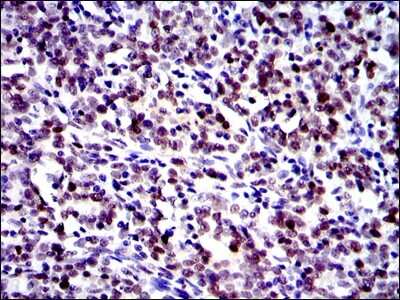 Immunohistochemistry: c-jun Antibody (4H9) [NBP2-37571] - Immunohistochemical analysis of paraffin-embedded cervical cancer tissues using c-Jun mouse mAb with DAB staining.