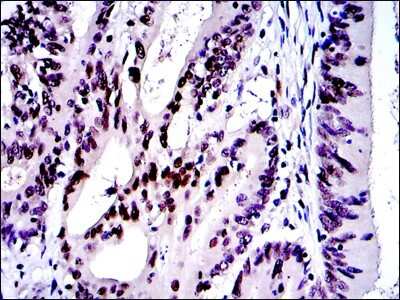 Immunohistochemistry: c-jun Antibody (4H9) [NBP2-37571] - Immunohistochemical analysis of paraffin-embedded colon cancer tissues using c-Jun mouse mAb with DAB staining.